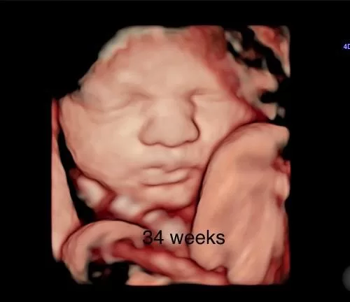 34 week baby ultrasound miami