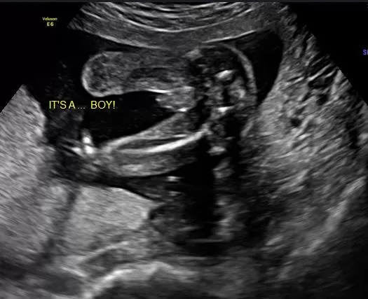 Ultrasound Gender Determination