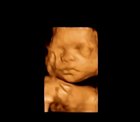 baby ultrasound miami