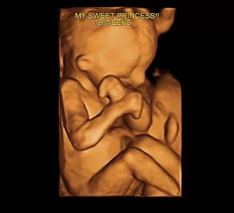 best 19 week baby ultrasound miami