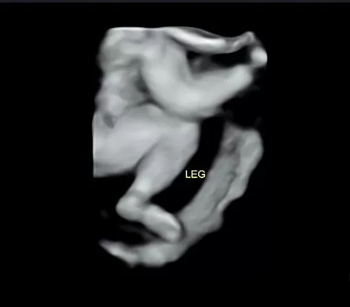 leg baby ultrasound miami